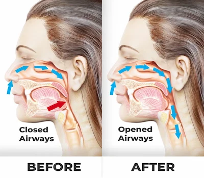 Benefits of SnoreStop Spray