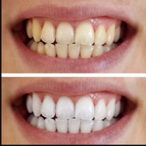 WellaWhite Teeth Whitening Foam Before & After